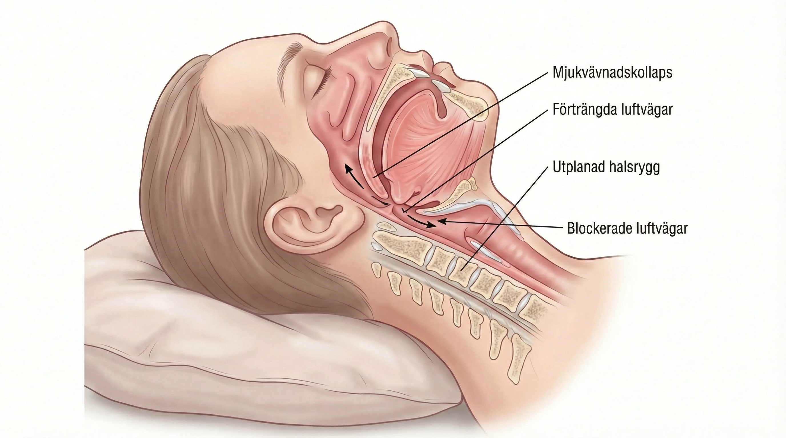 Diagram som visar kollaps i luftvägen i halsen med utplattad halsrygg och blockerad luft
